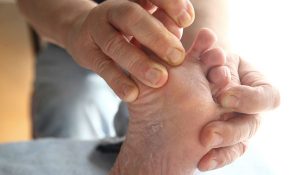 Home Remedies for Athlete’s Foot – 10 Natural Treatments